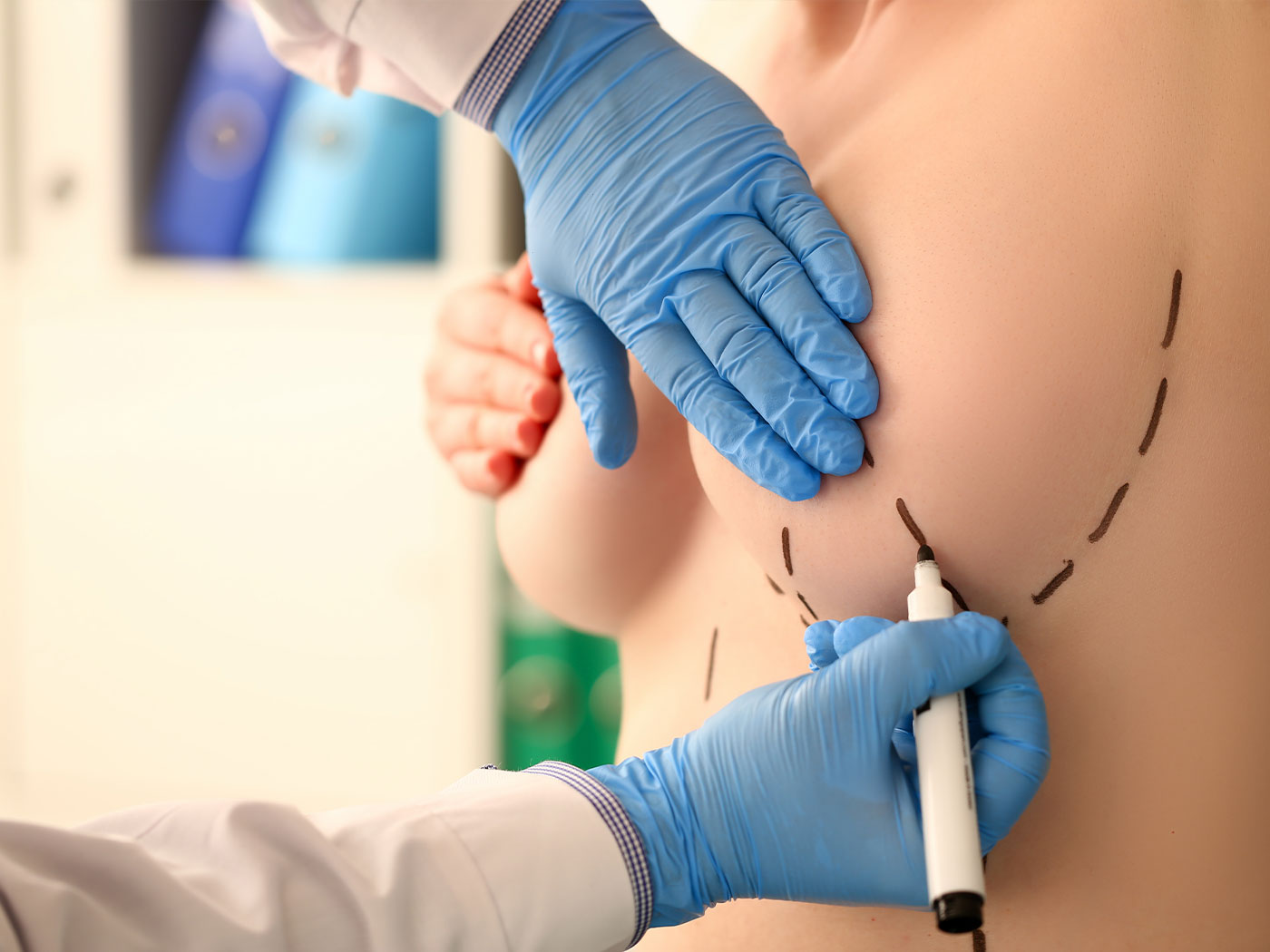 Plastic surgery | Breast augmentation with silicone