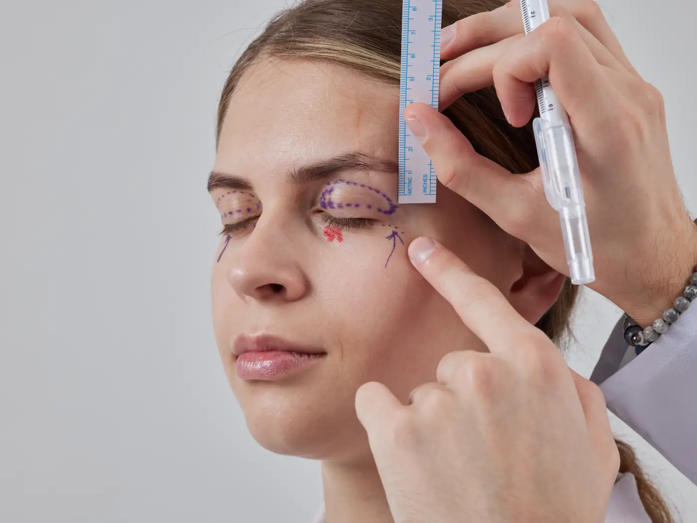 Plastic surgery | Eyelid surgery