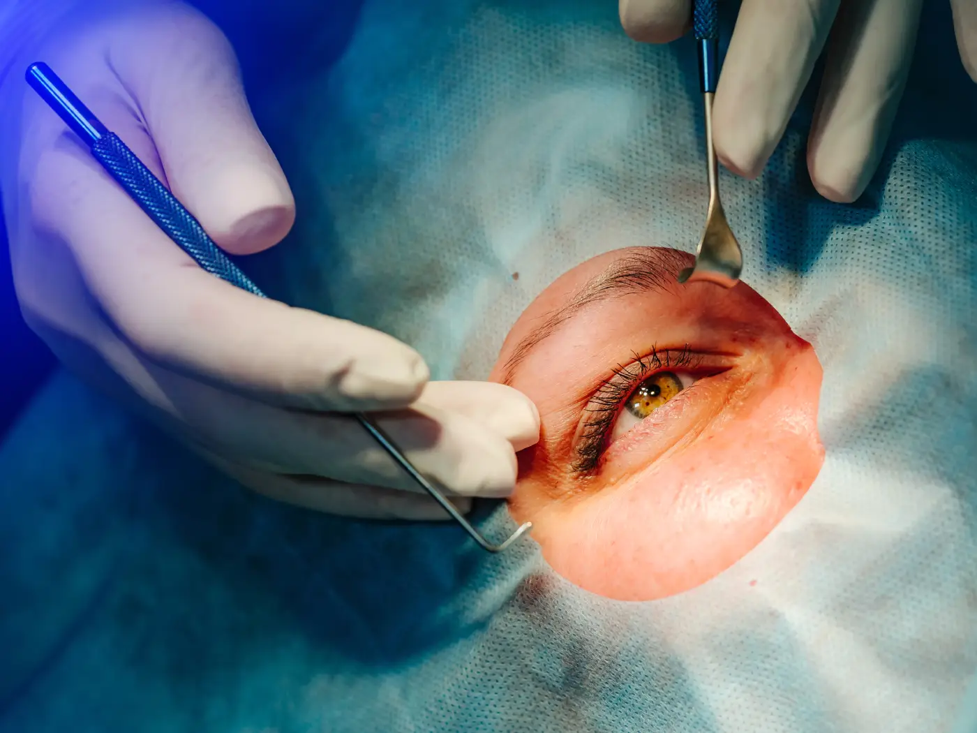 Пластична хирургија | Да ли је операција капака болна?