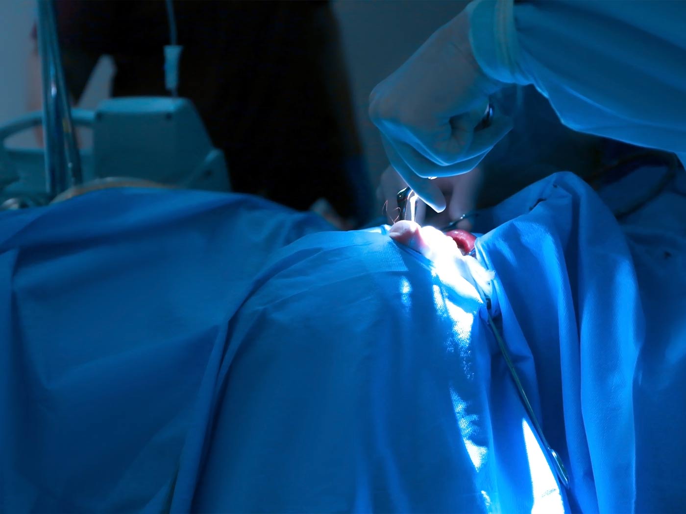 Plastična hirurgija | Hirurško lečenje sinuzitisa metodom FESS