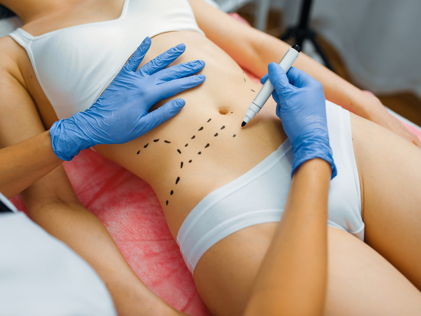 Plastična hirurgija | Šta sve treba da znate o liposukciji?