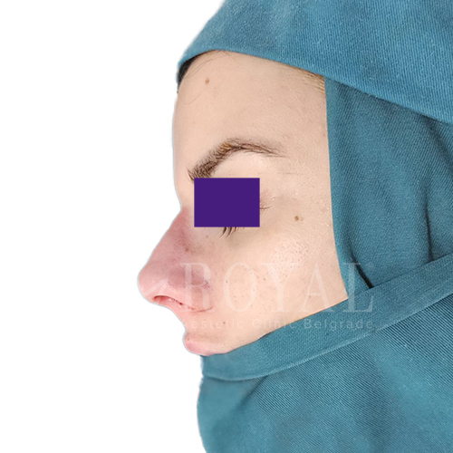 Plastična hirurgija | Pre i posle