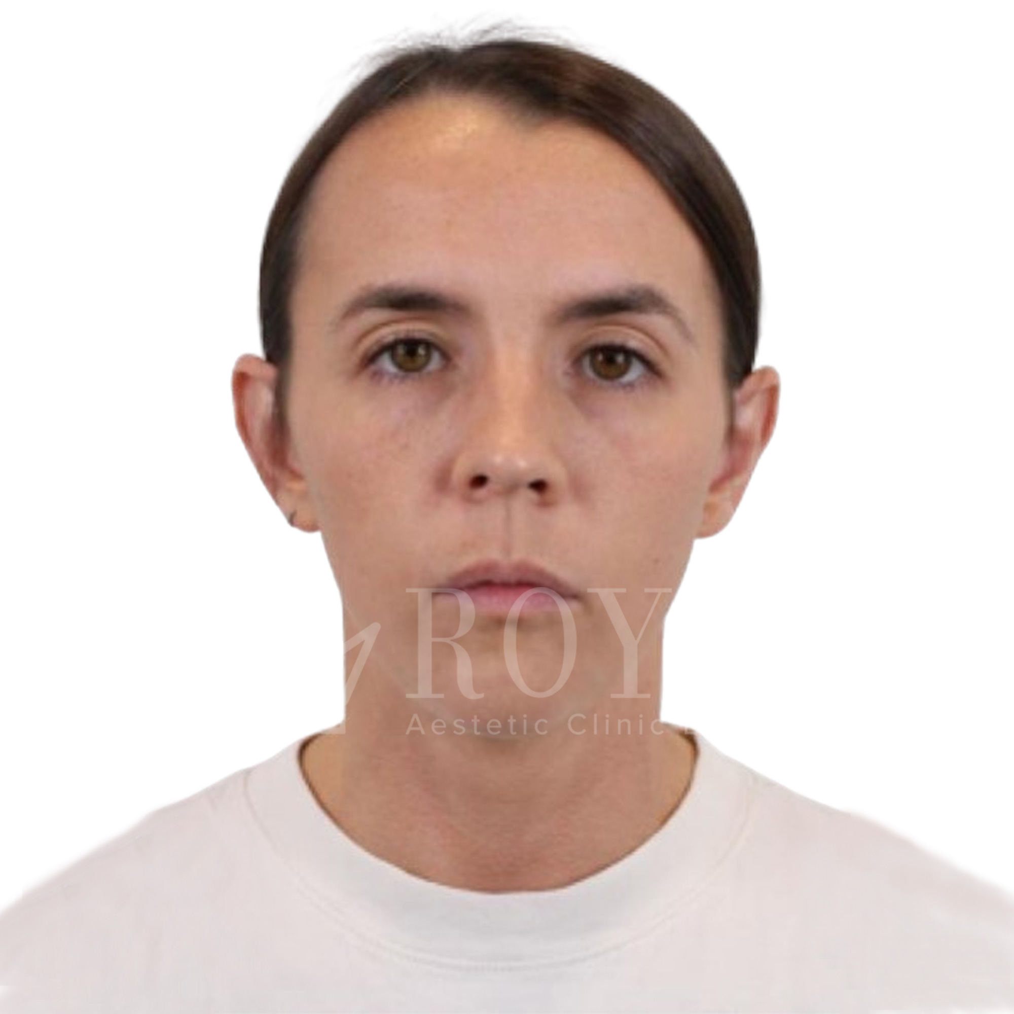 Plastična hirurgija | Pre i posle