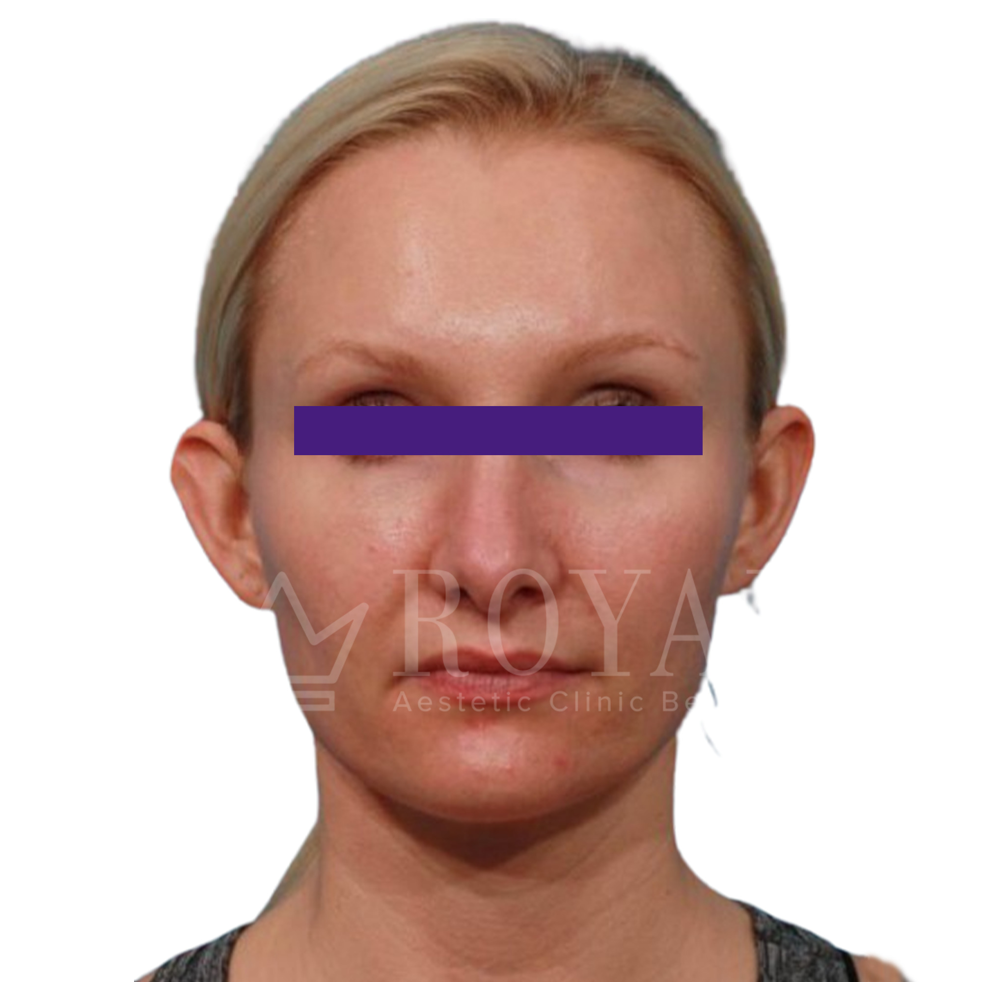 Plastična hirurgija | Pre i posle