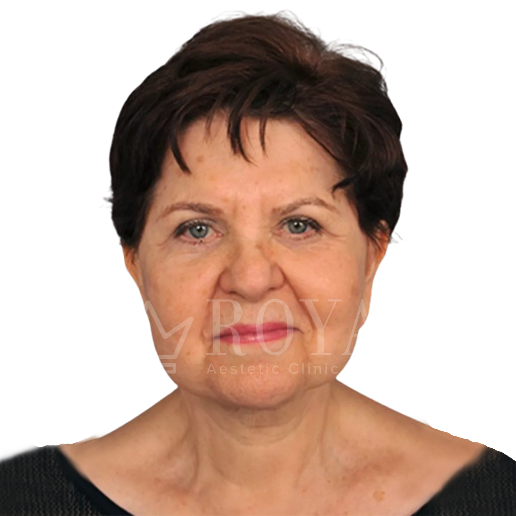 Plastična hirurgija | Pre i posle