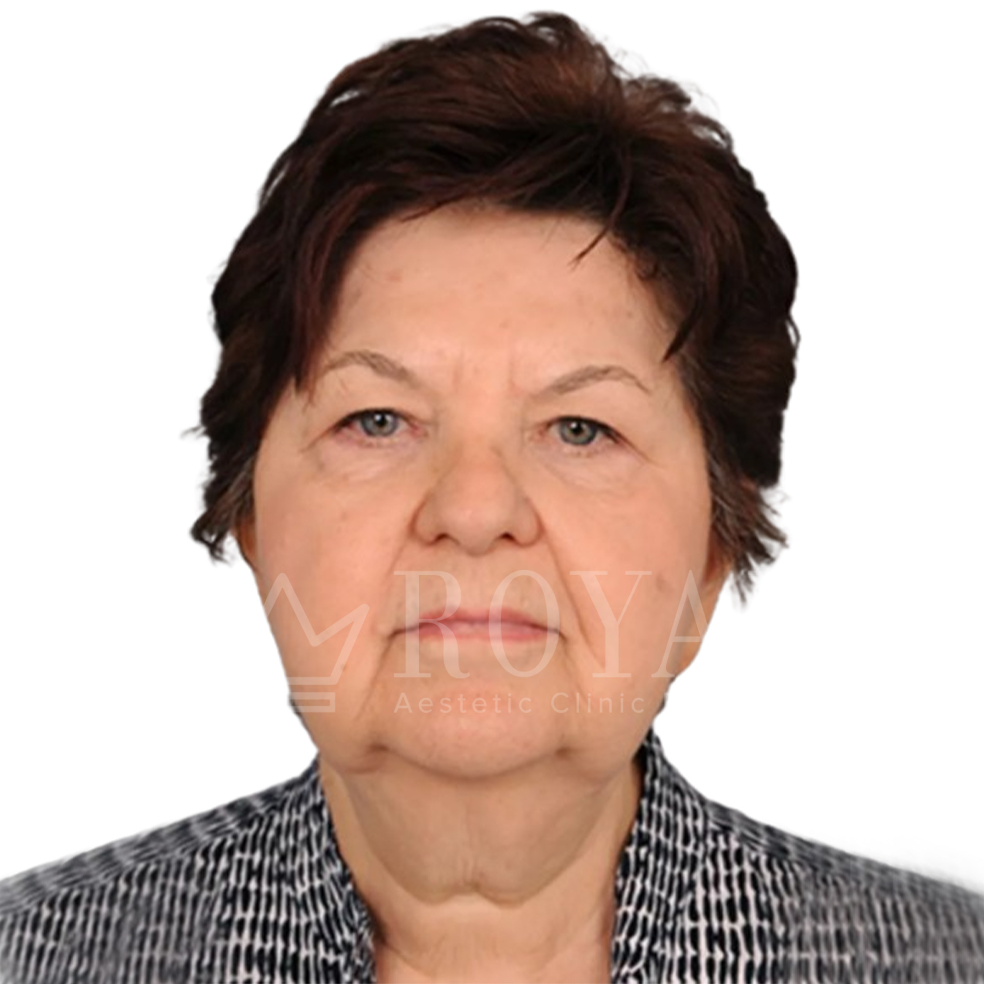 Plastična hirurgija | Pre i posle
