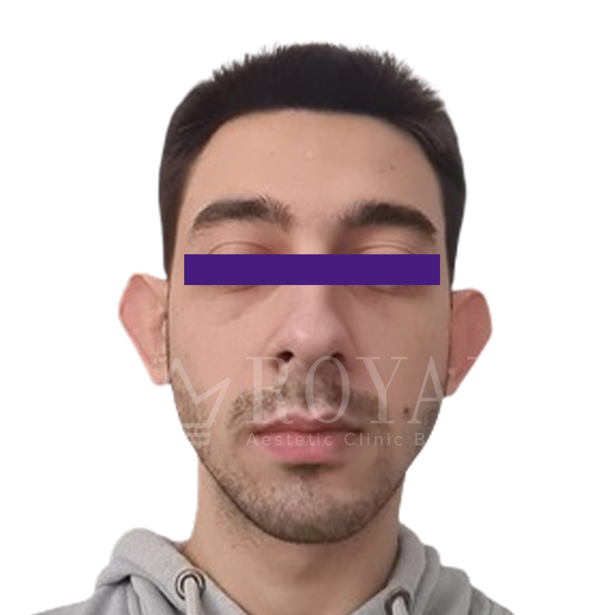 Plastična hirurgija | Pre i posle