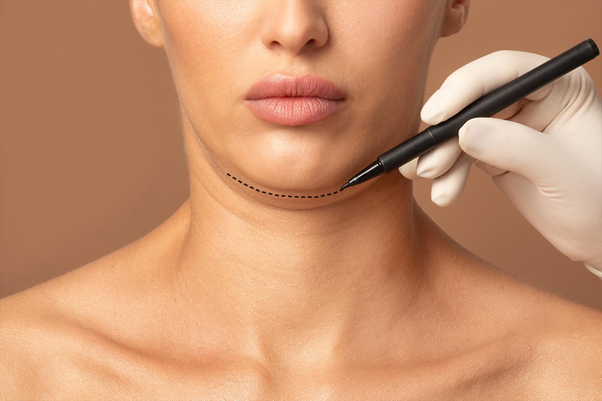 Chin liposuction | Chin liposuction