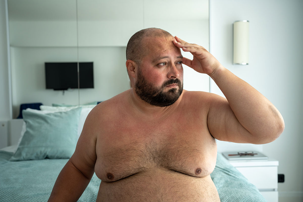 Gynecomastia | Gynecomastia