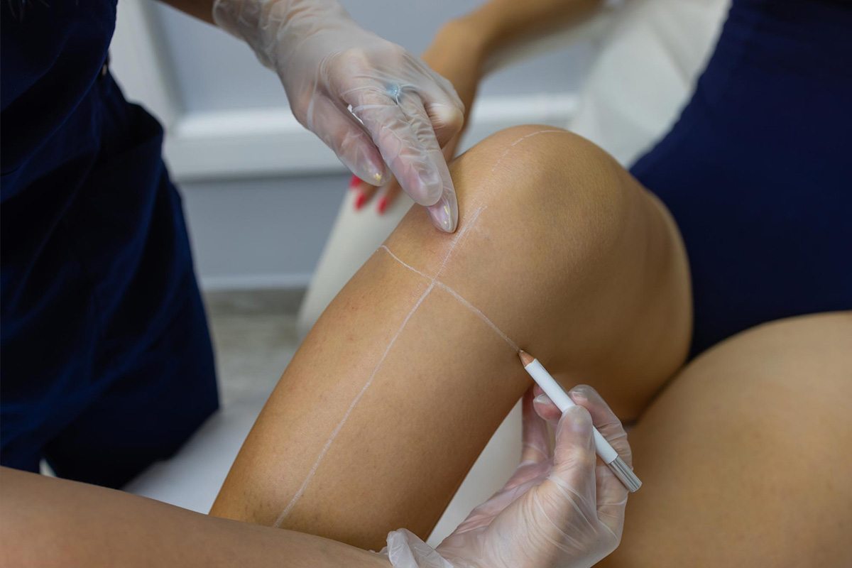 Liposukcija kolena | Liposukcija kolena