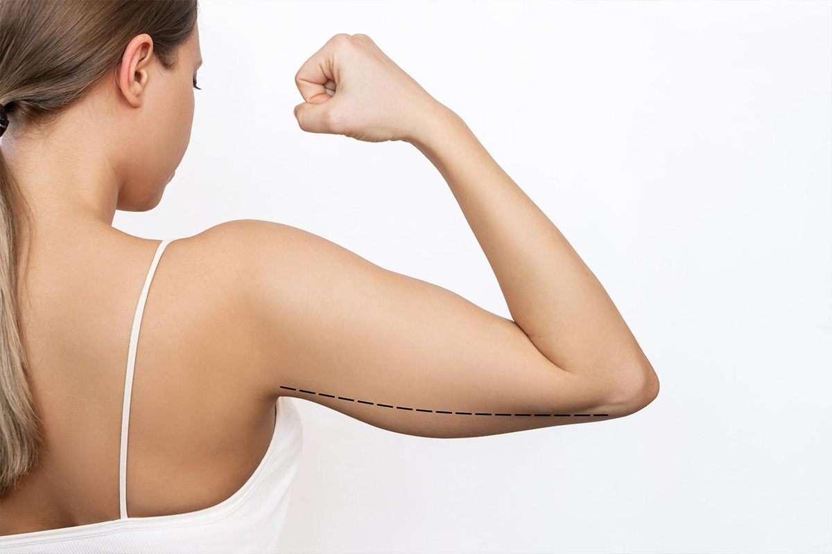 Liposukcija nadlaktice | Liposukcija nadlaktice