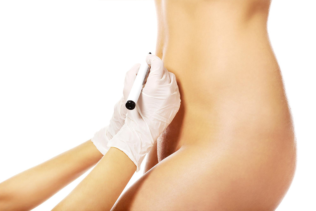 Liposukcija pubične regije | Liposukcija pubične regije