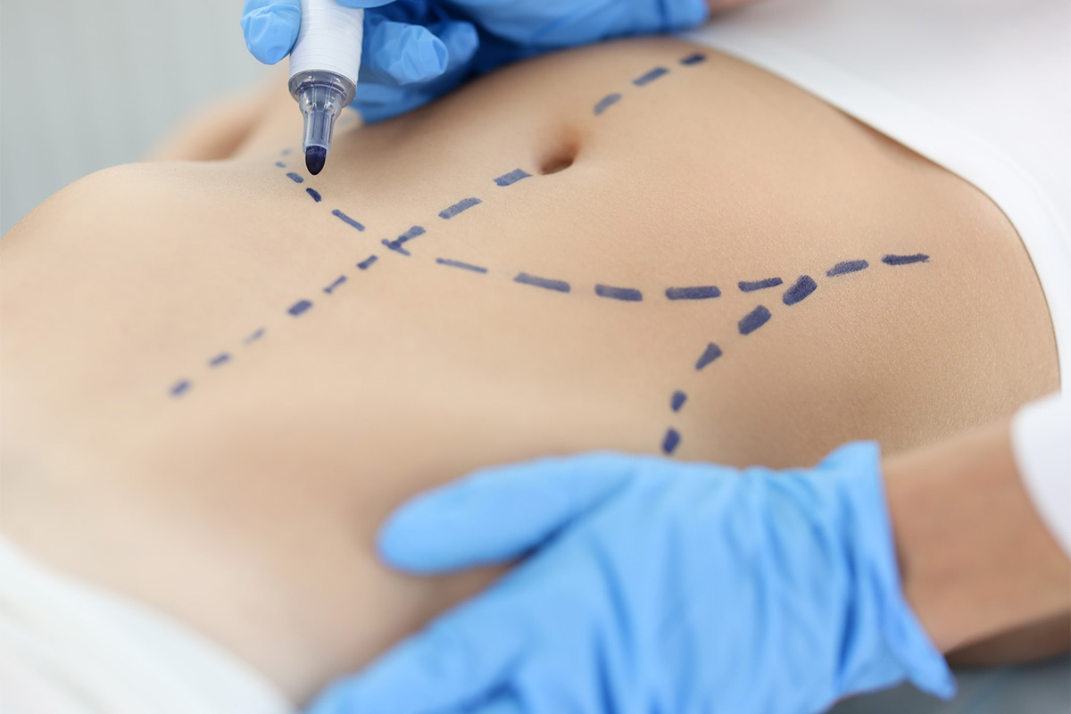 Liposukcija | Liposukcija